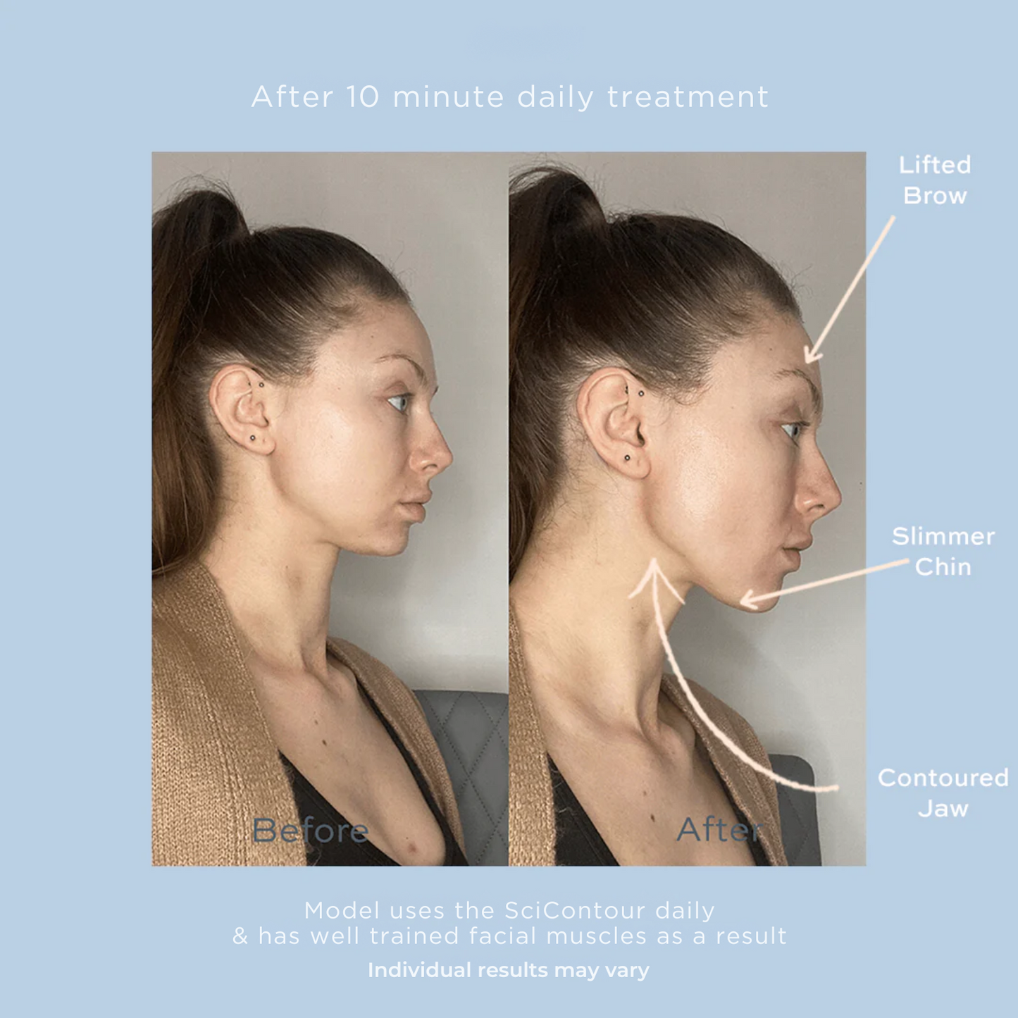 SciContour Face Cupping Device